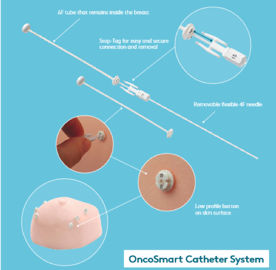 oncosmart导管系统GyD.F4y2Ba